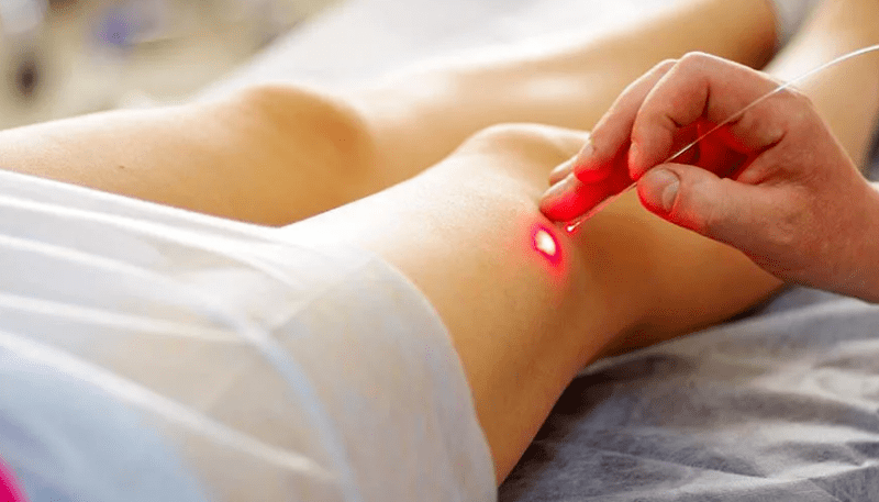 Laserska koagulacija krčnih žil