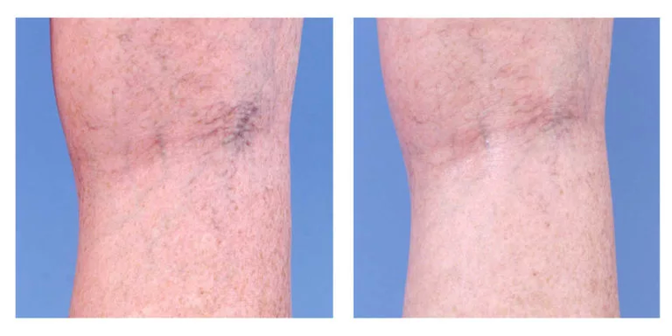 Kozmetični popravek